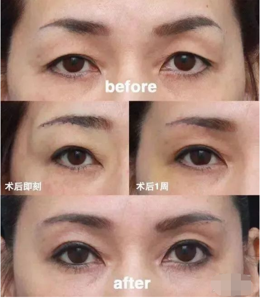 中老年的三角眼是怎么造成的