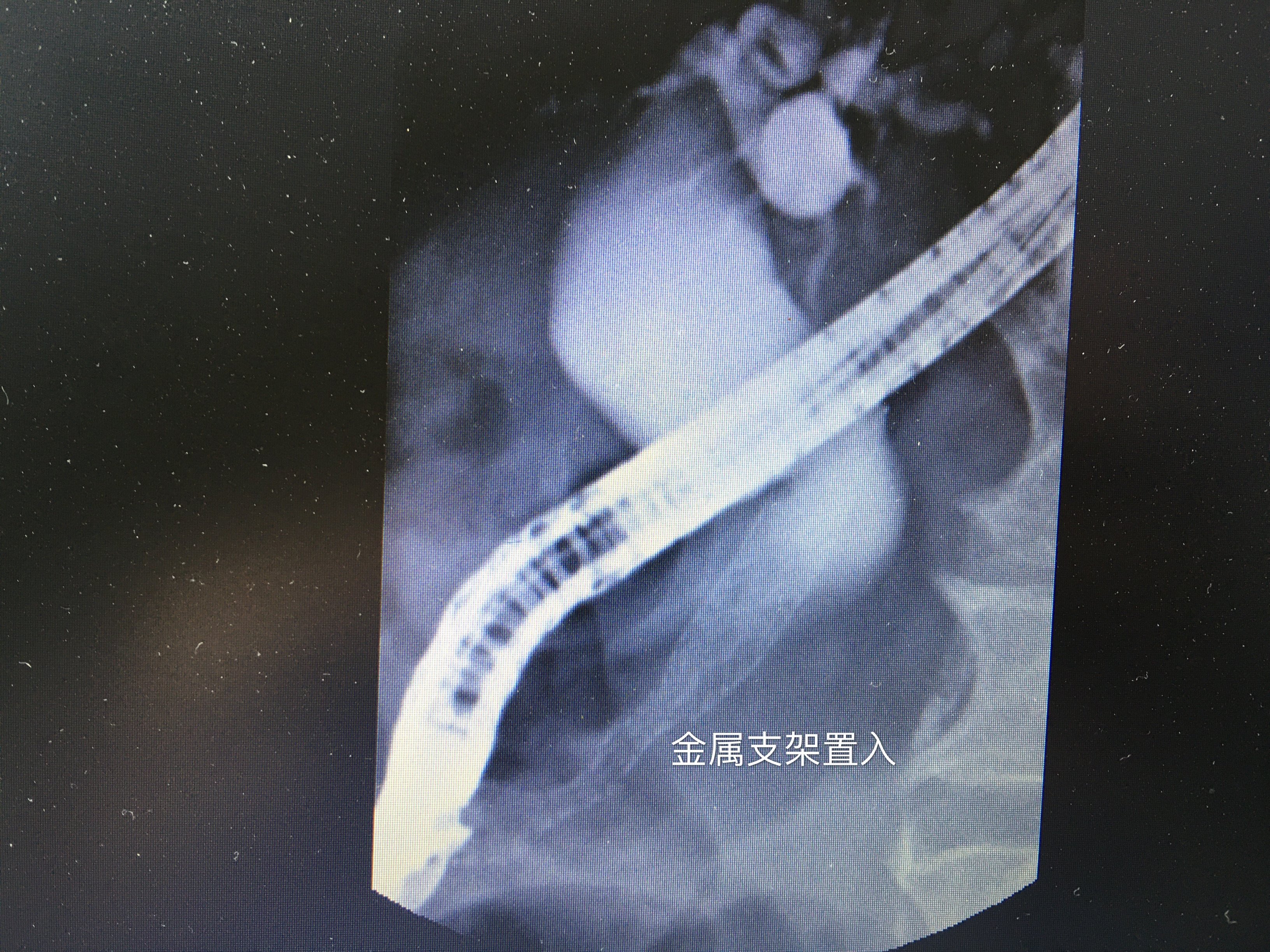 晚期胰腺癌出现黄疸时的治疗_胰腺癌_胰腺癌治疗方式 - 好大夫在线