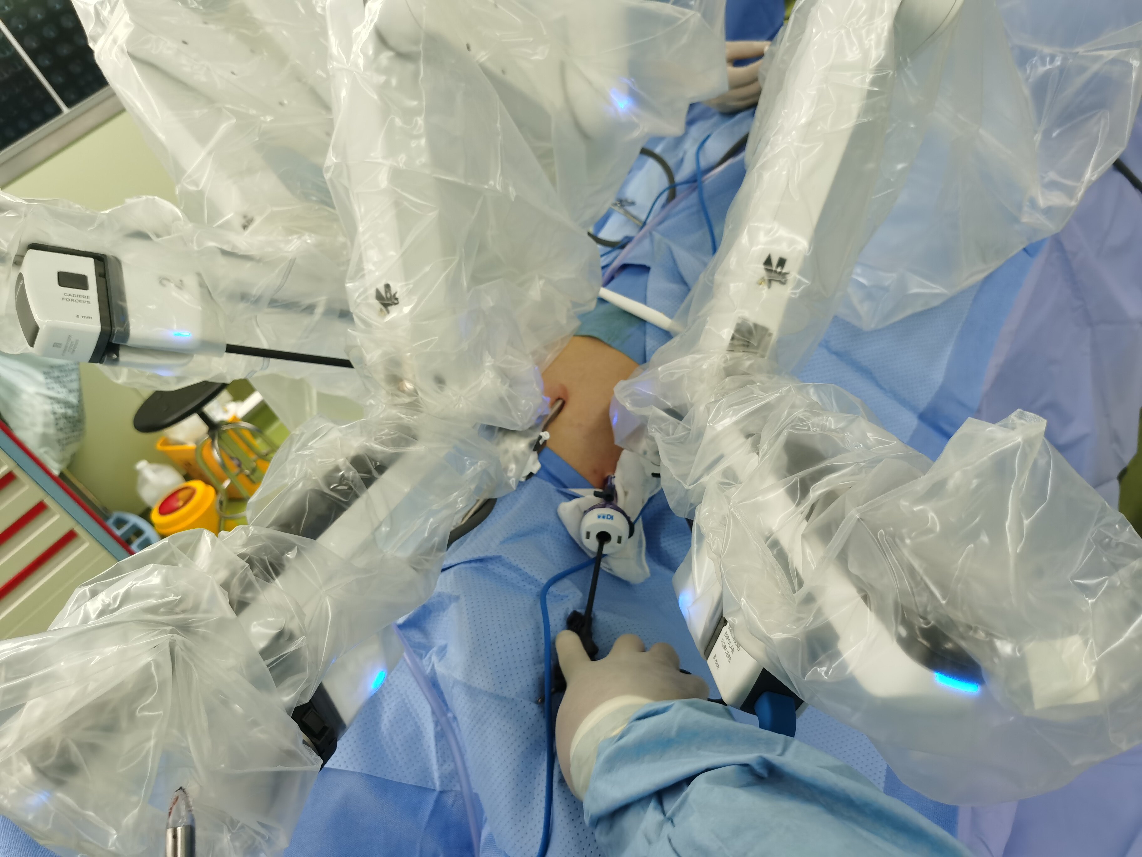 四个8mm孔微创解决疾病可见左侧腹腔内容物疝入胸腔内术前检查患者男