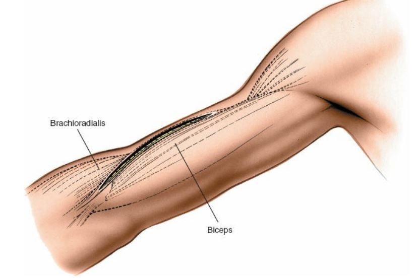 如何采用肱骨前外侧入路治疗上臂肱骨干中1/3段骨折? - 好大夫在线
