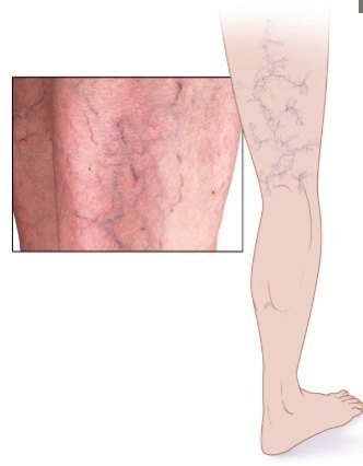 静脉曲张_静脉曲张症状表现 - 好大夫在线