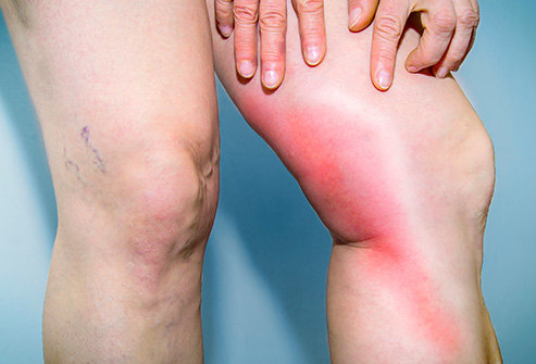 493ss_thinkstock_rf_deep_vein_thrombosis.jpg