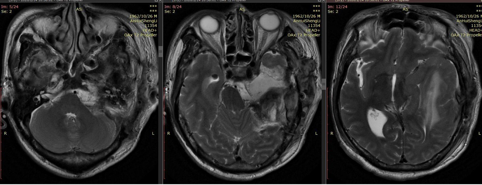 疫情下的巨大岩斜坡脑膜瘤-10.jpg