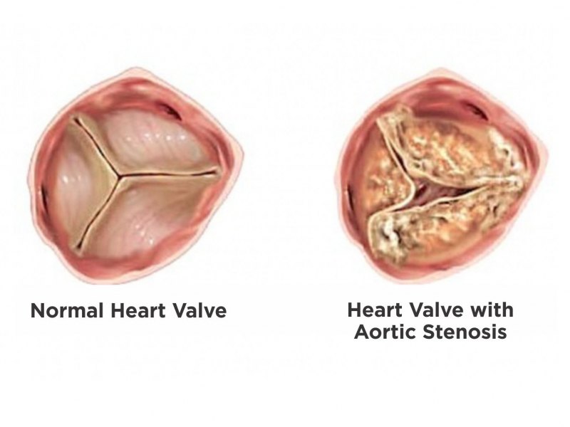 aorticstenosis_104e692622ca792974c04428795f5303__800x600__0x0.jpg