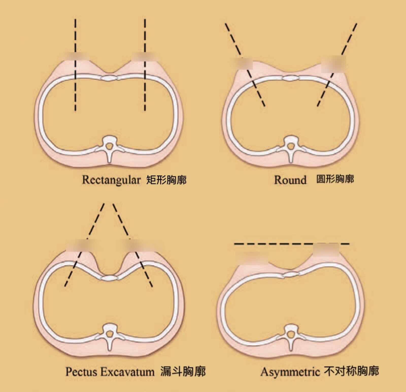 假體隆胸能否做出明顯的乳溝