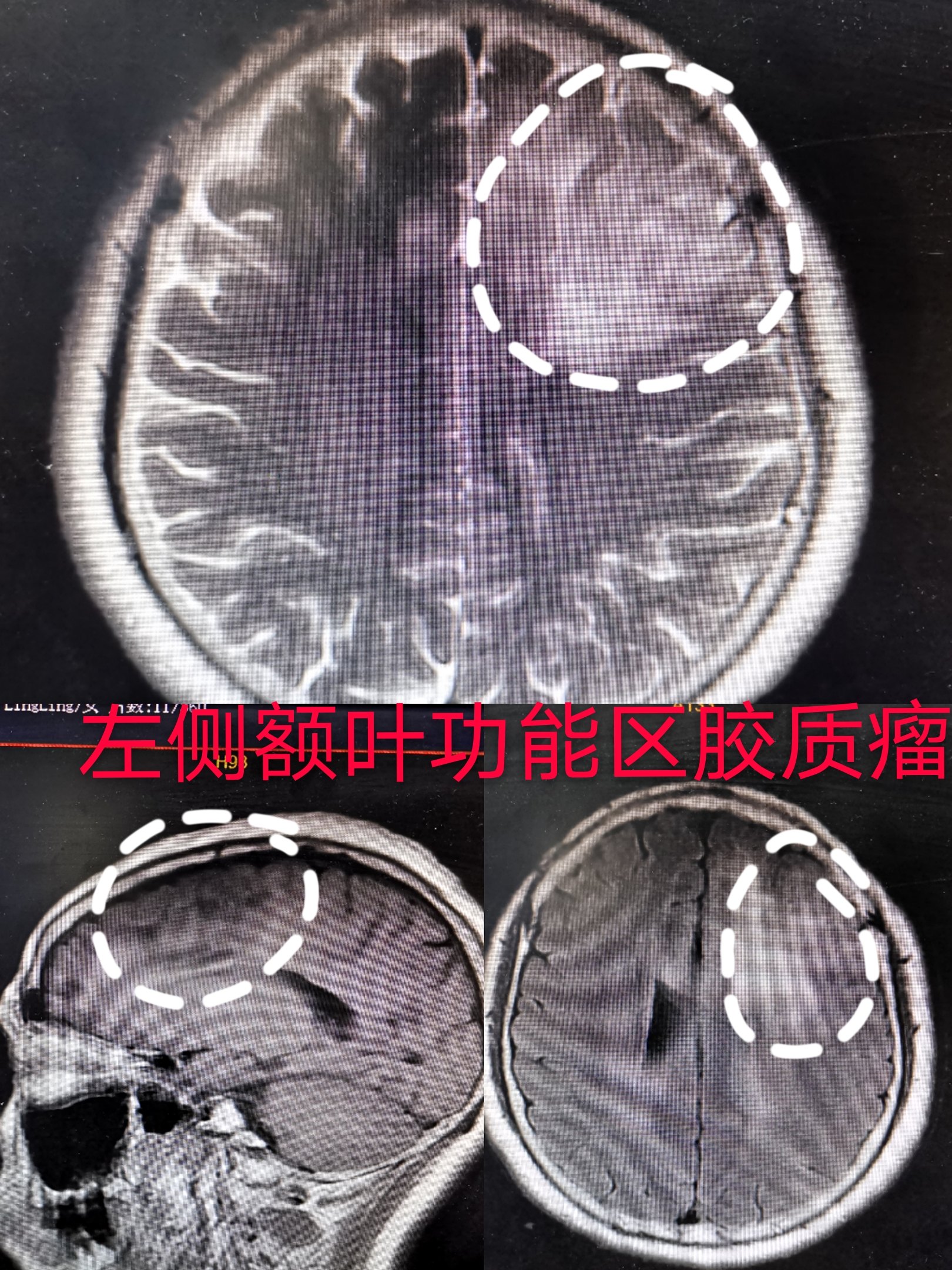 近期功能区胶质瘤3例总结