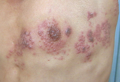 病毒性皮肤病之带状疱疹_带状疱疹_介绍_治疗方式 - 好大夫在线