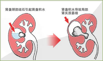 得了結石病腎結石輸尿管結石膀胱結石尿道結石怎麼辦