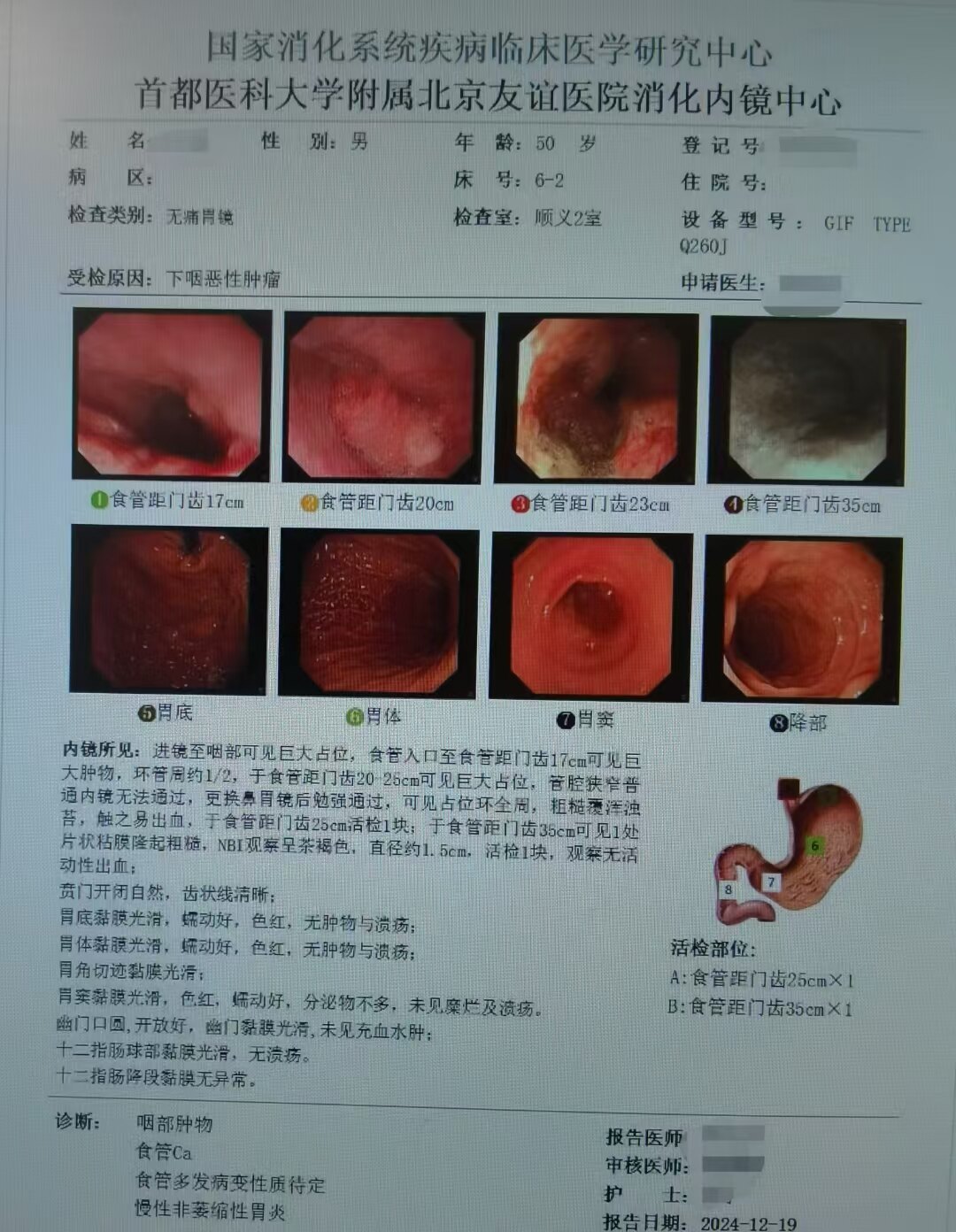 病例1:下咽癌伴食管多原发鳞状细胞癌的综合治疗 - 好大夫在线