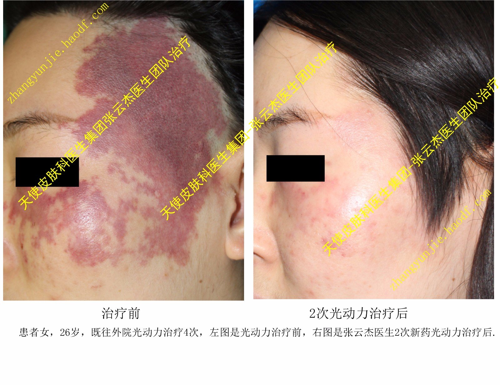 海姆泊芬光动力治疗后基本痊愈如何找张云杰医生做治疗