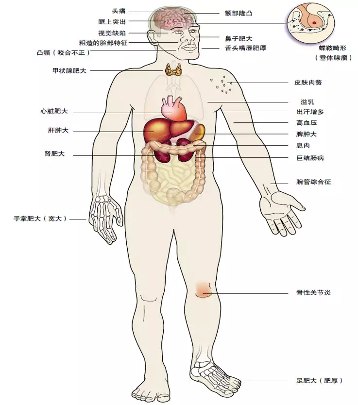 国际罕见病日 关注隐形的杀手 肢端肥大症 肢端肥大症 肢端肥大症