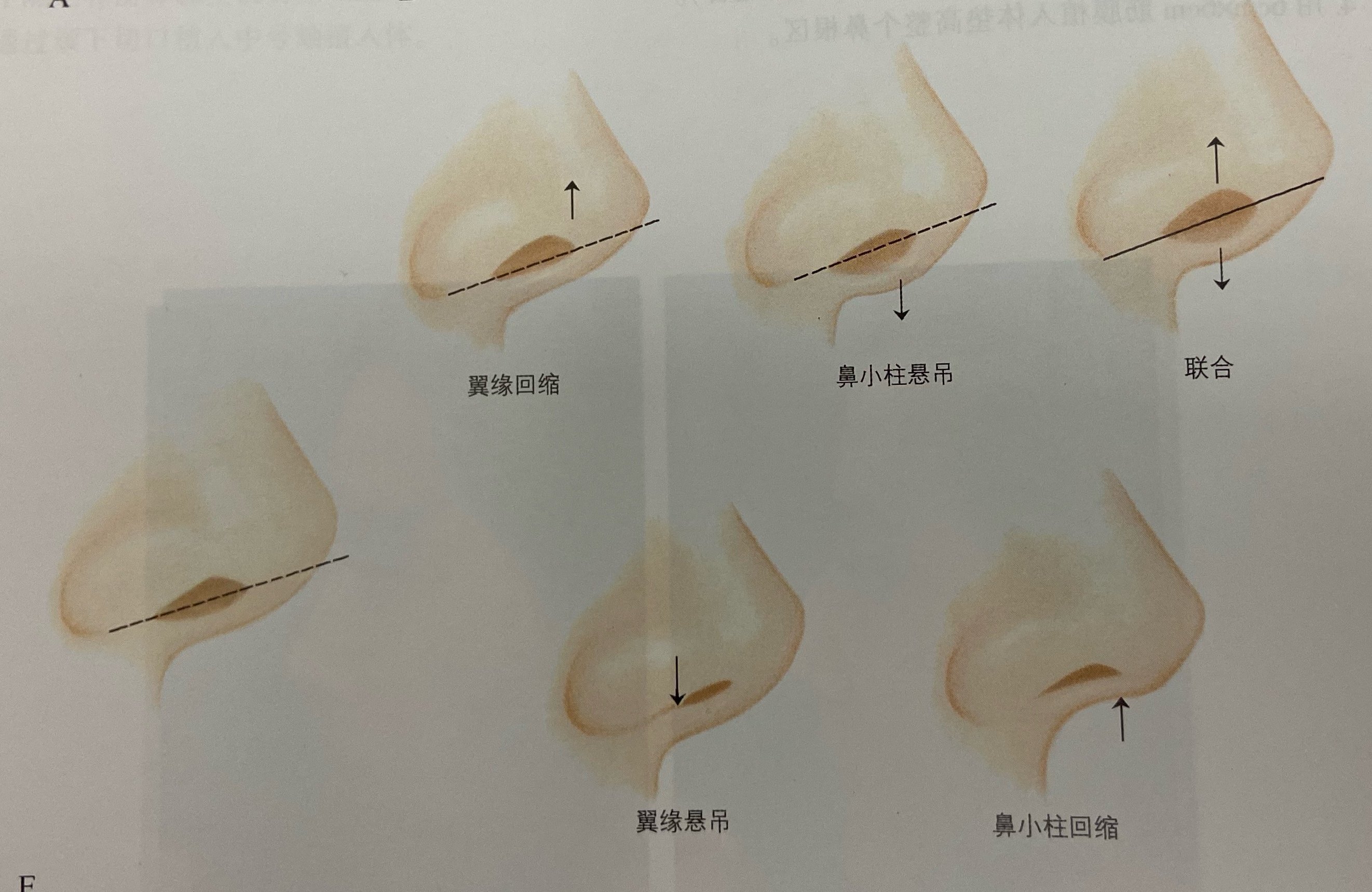 鼻翼缘下垂图片