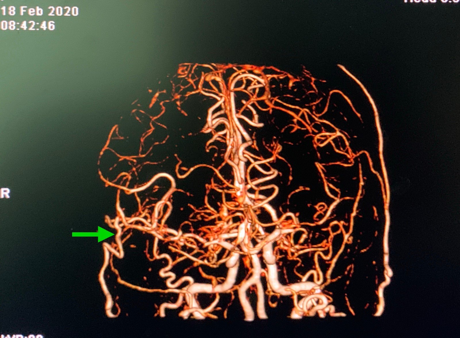 新冠肺炎疫情期间烟雾病手术病例报告 - 好大夫在线