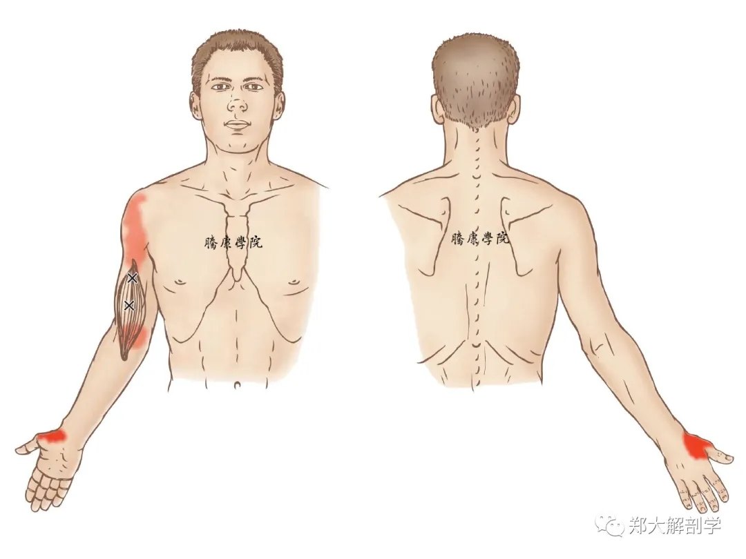 肱肌扳机点病因:急性或慢性的肌肉过度使用(例如:尤其是前臂完全旋前