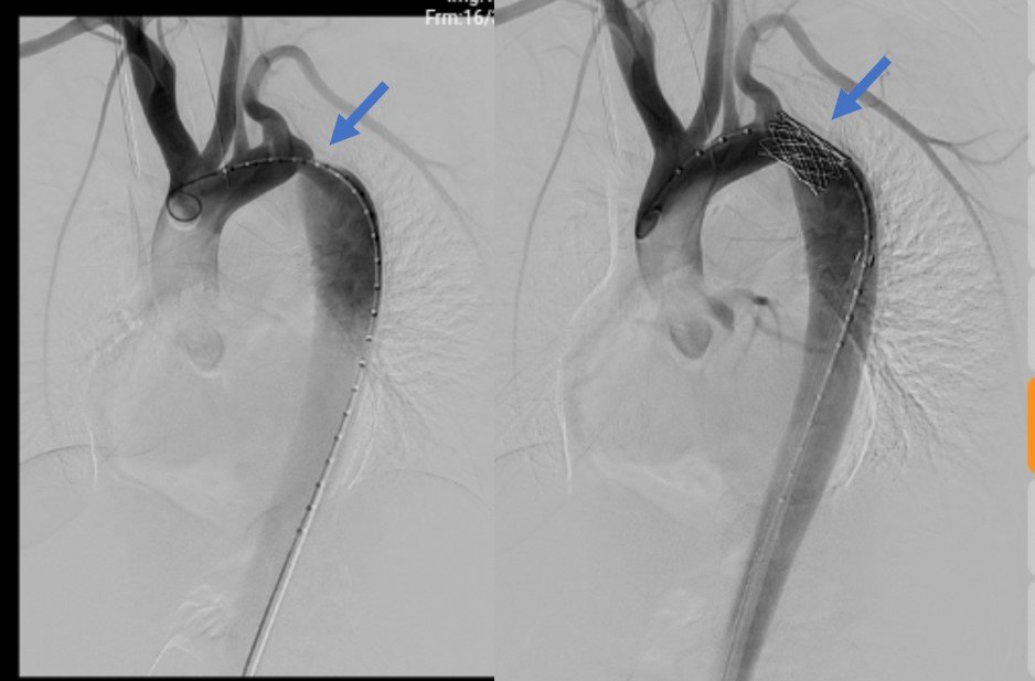 haodf:8:zhudongmaisuozhai-->主动脉缩窄 !
