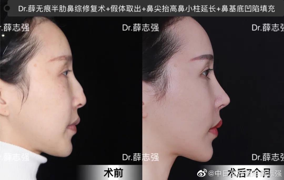 4 0鼻综合丨直鼻 翘鼻哪个更适合你 鼻部整形 鼻部整形治疗介绍 好大夫在线 4 0鼻综合丨直鼻 翘鼻哪个更适合你 鼻部整形 鼻部整形治疗介绍 好大夫在线