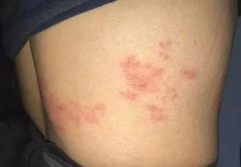 超"痛"的皮肤病---带状疱疹_带状疱疹 - 好大夫在线