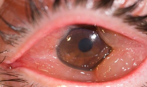 严重的时候接触过敏原后会迅速出现结膜水肿(就是白眼球有水泡)