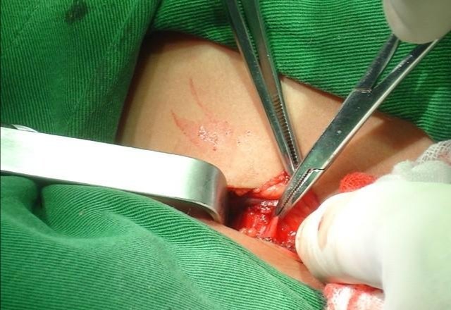 斜颈手术指征与手术方式是什么?