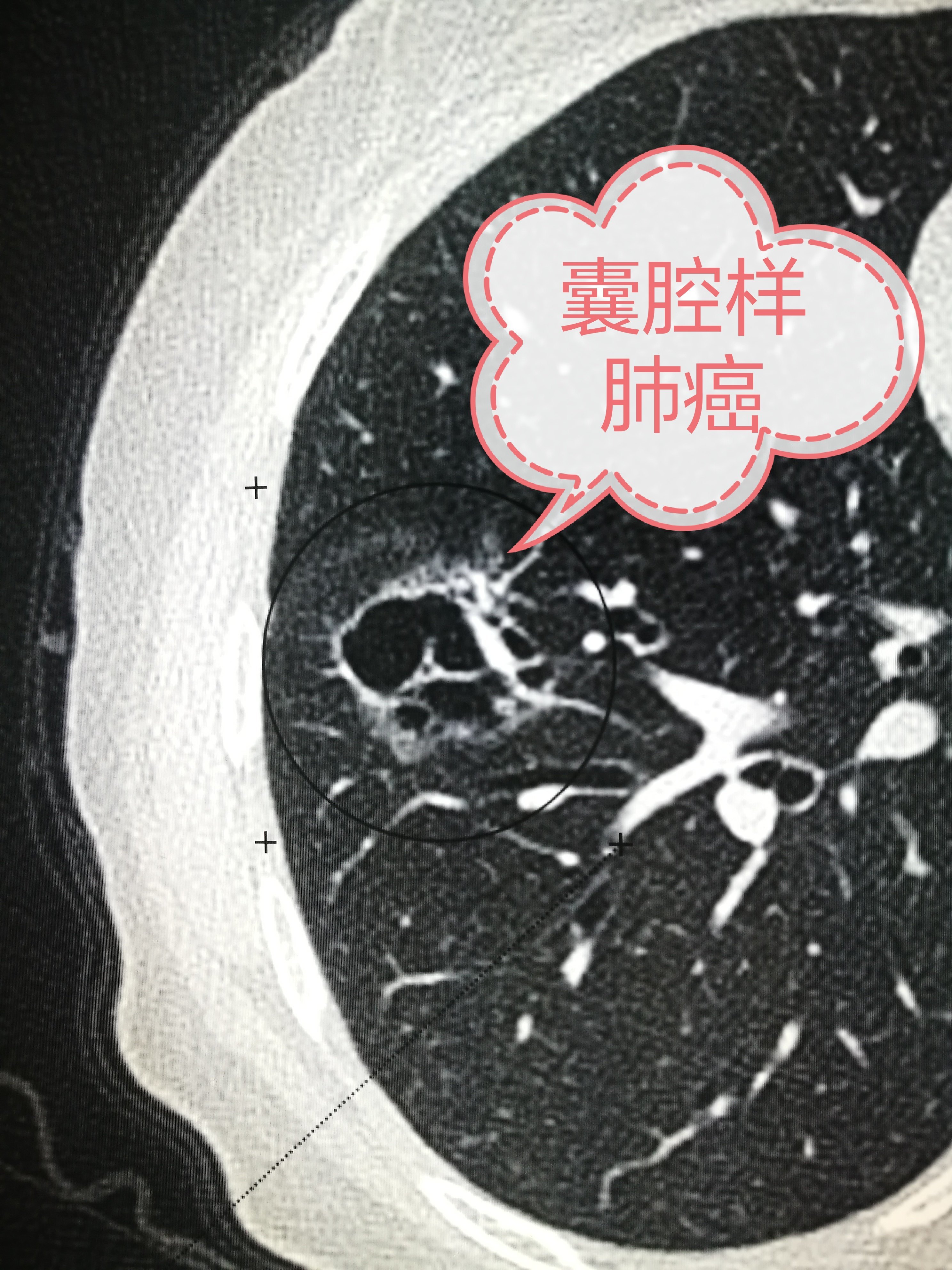 肺泡真实图片图片