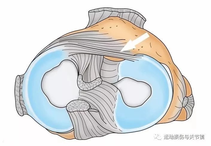 盘状半月板发病率图片