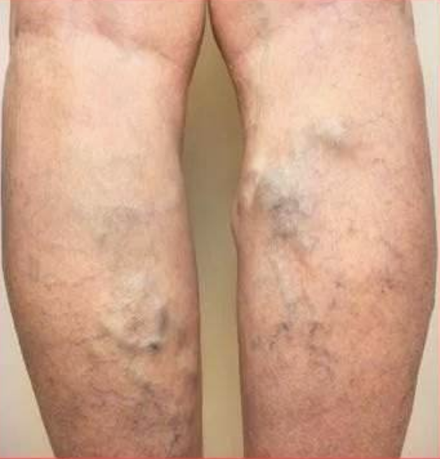 腿部青筋凸起对患者有什么影响?
