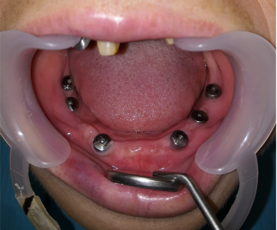 牙齿种植_牙齿种植治疗方式 - 好大夫在线