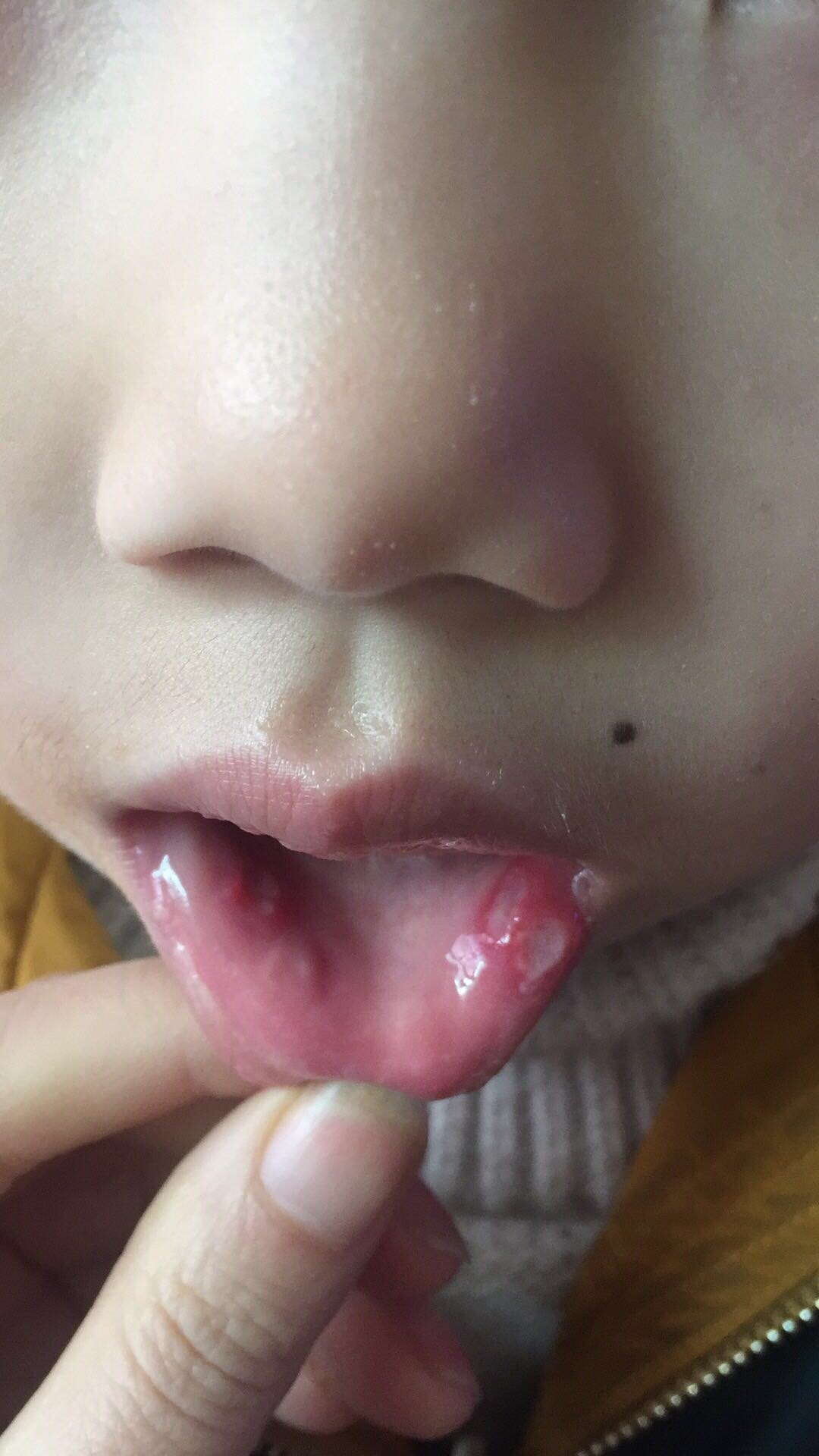 孩子口腔溃疡图片图片