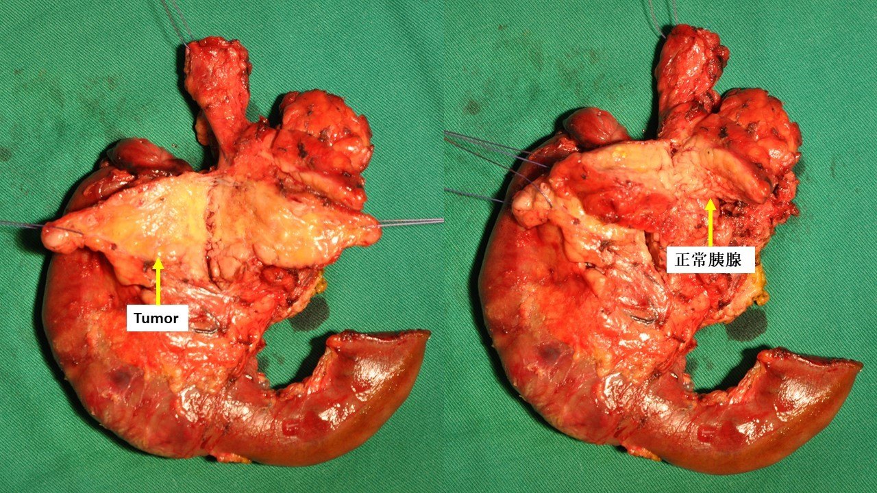 胰腺癌早期图片