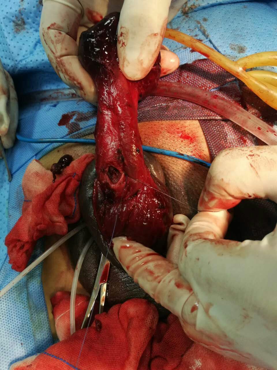 阴茎海绵体折断,需要及时修补