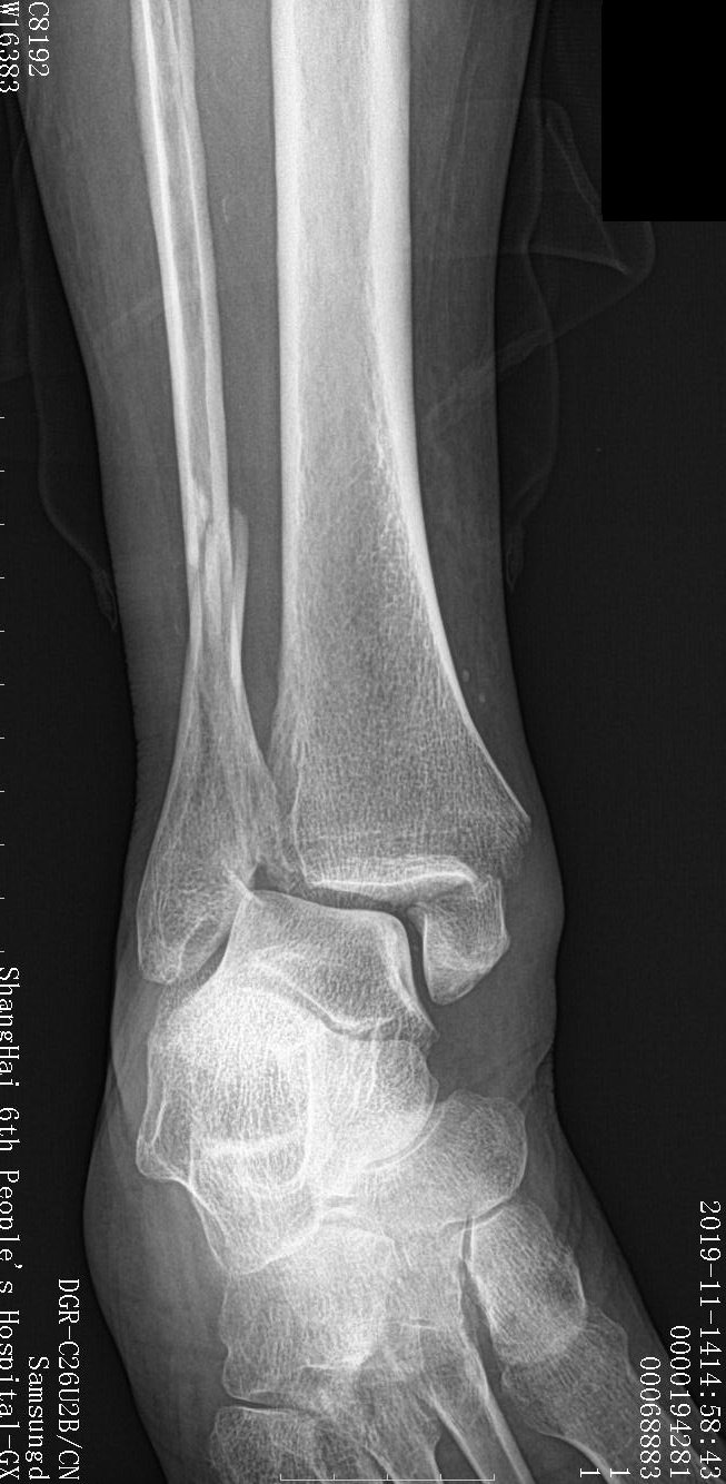 腓骨骨折需要手术吗 胫腓骨骨折 好大夫在线