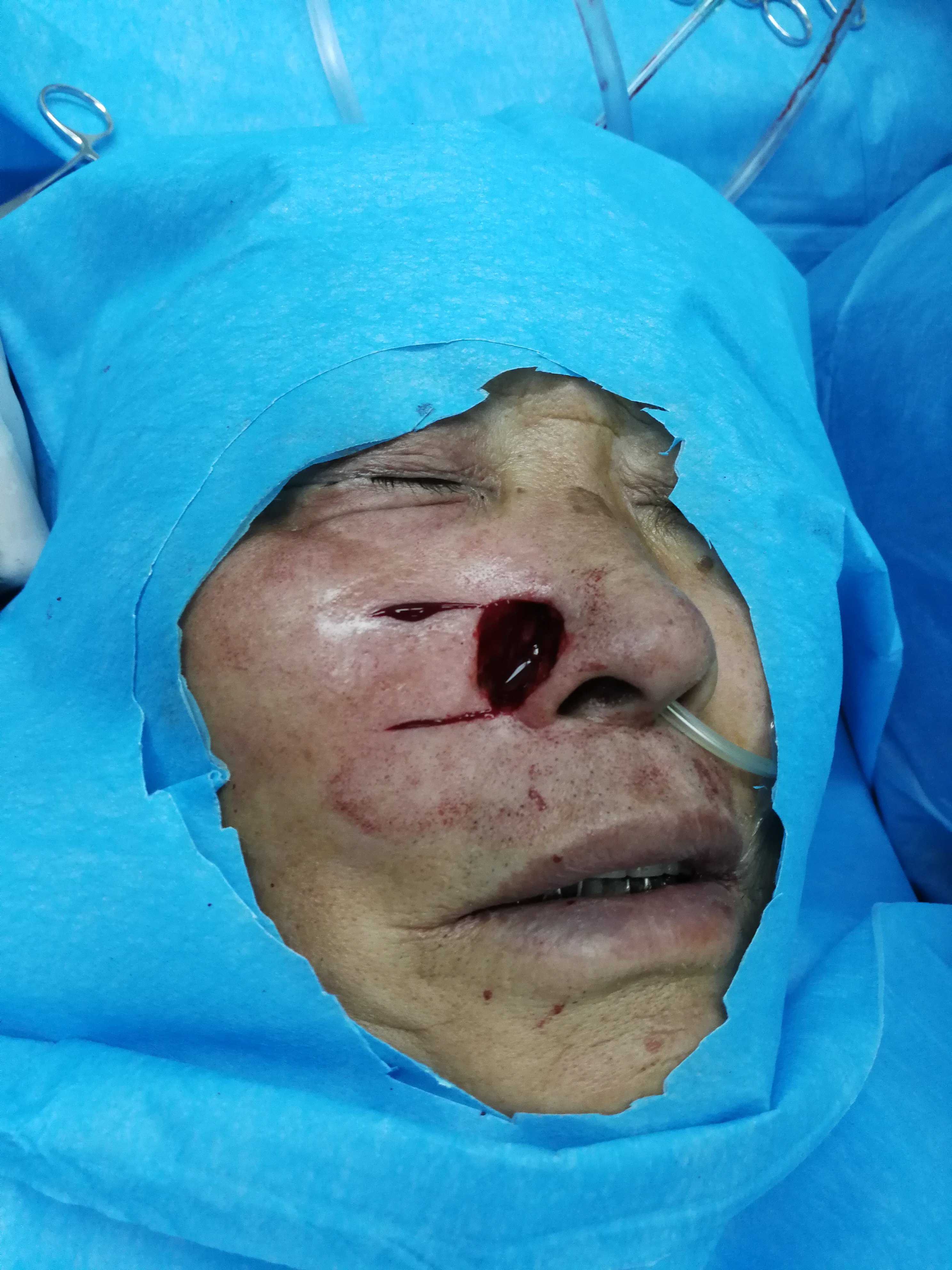 鼻翼肿瘤切除术