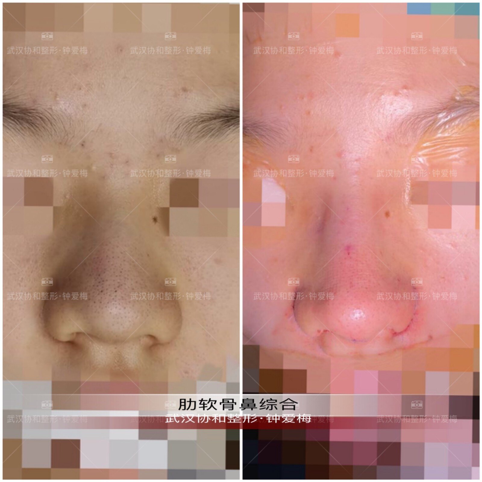 钟爱梅医生肋软骨鼻综合案例分享 肉趴鼻的改变 鼻部整形 好大夫在线 钟爱梅医生肋软骨鼻综合案例分享 肉趴鼻的改变 鼻部整形 好大夫在线