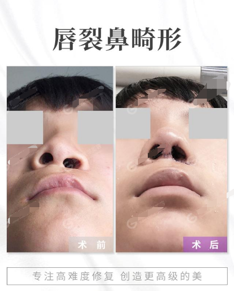 唇腭裂 - 好大夫在线