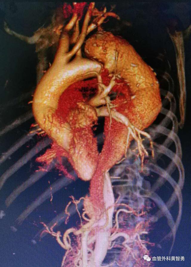 完成一例胸主动脉覆膜支架腔内隔绝术_主动脉夹层_如何预防_治疗方式