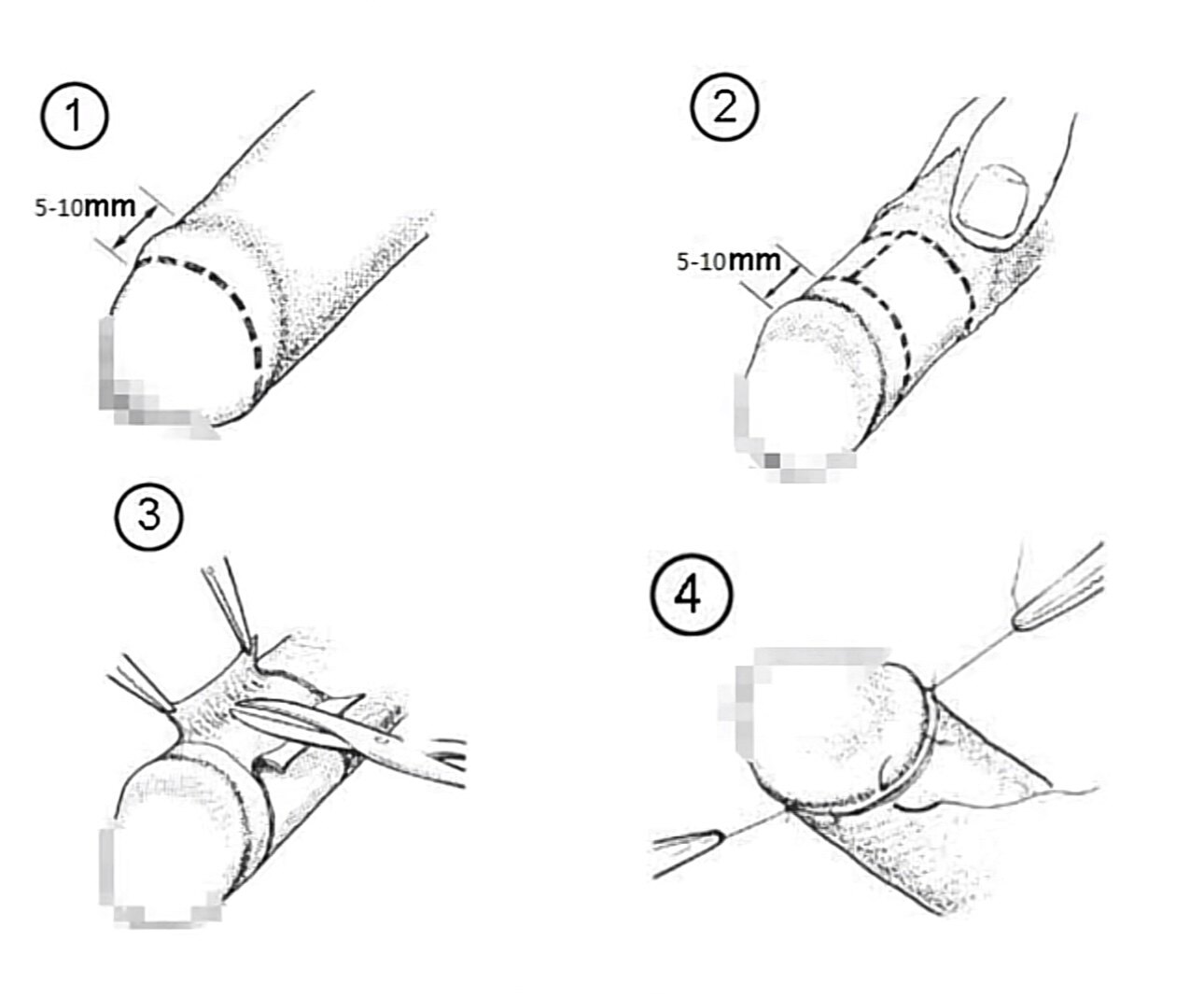关于"袖套式包皮环切术"你需要知道的内容