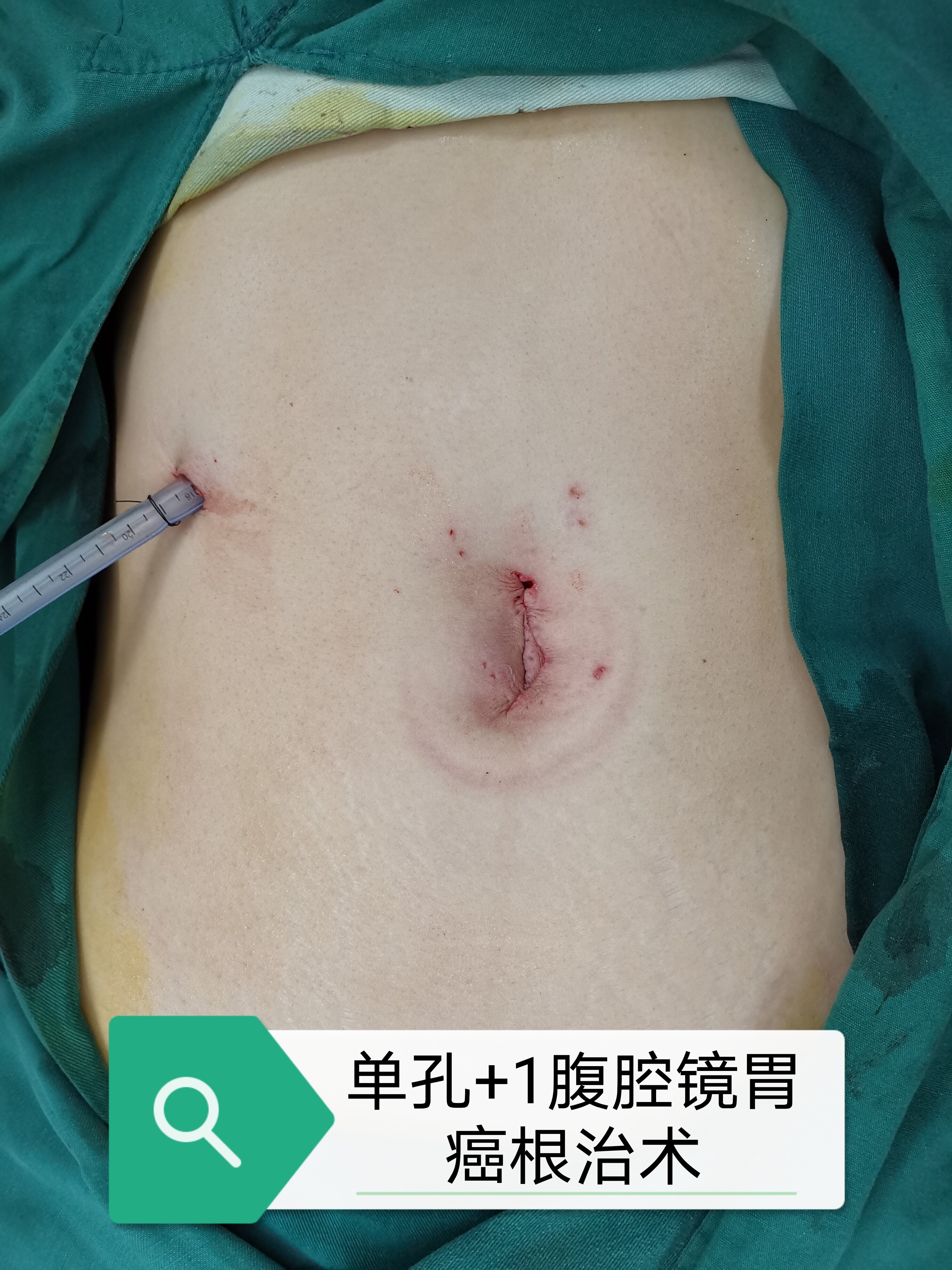 胃癌手术刀口图片图片
