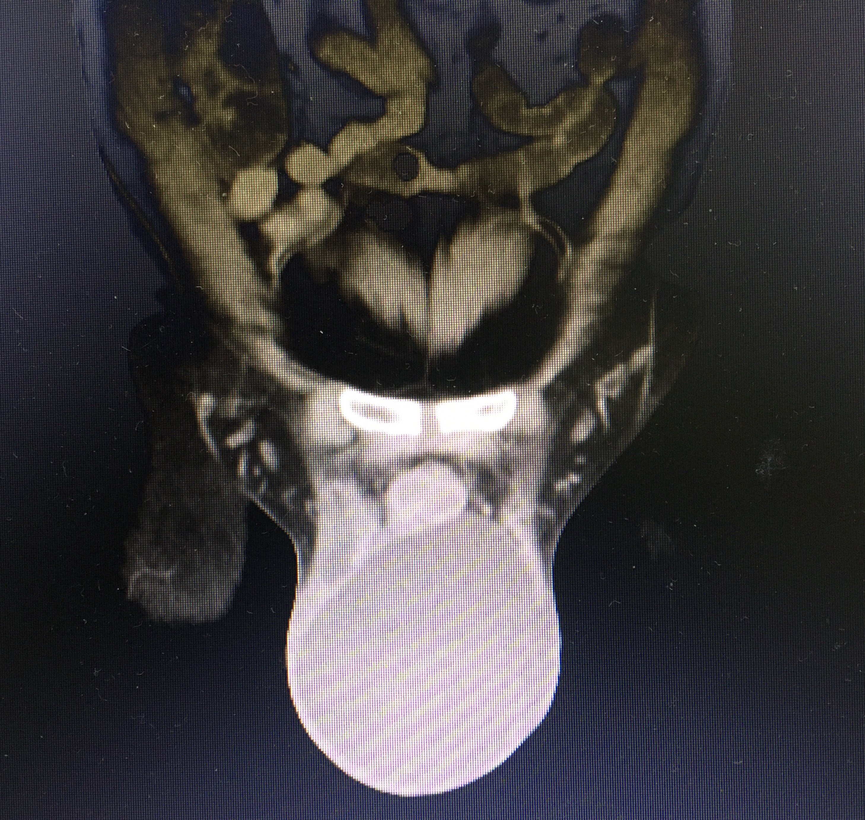 2歲以上患者如為交通性鞘膜積液或臨床症狀影響生活質量時也需手術