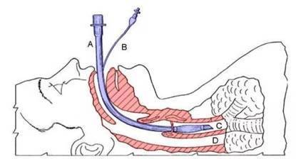 气管内插管图.jpg