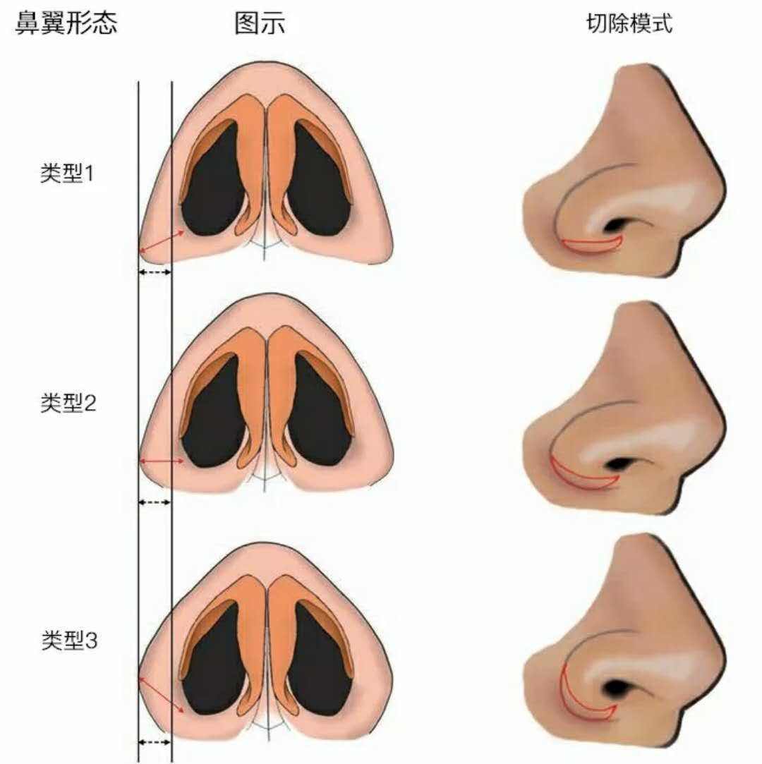 鼻头和鼻翼的位置图图片