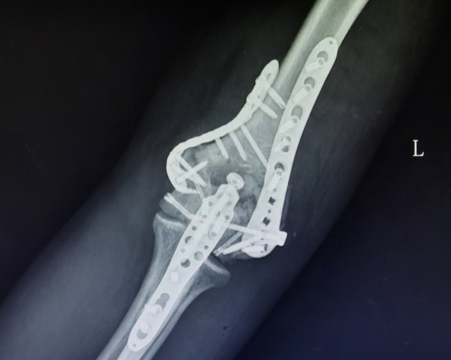 肱骨远端粉碎性骨折怎么办?_肱骨骨折_介绍_治疗方式 - 好大夫在线