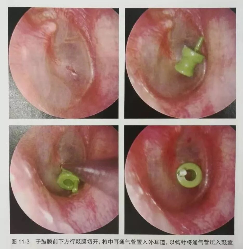 中耳炎置管图片图片