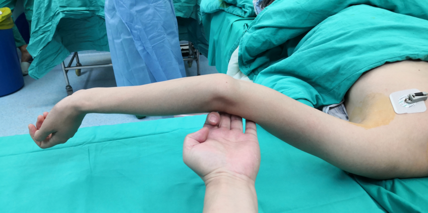 肱骨髁上楔形截骨矫正肘内翻——上海六院保肢专家文根_关节损伤_关节