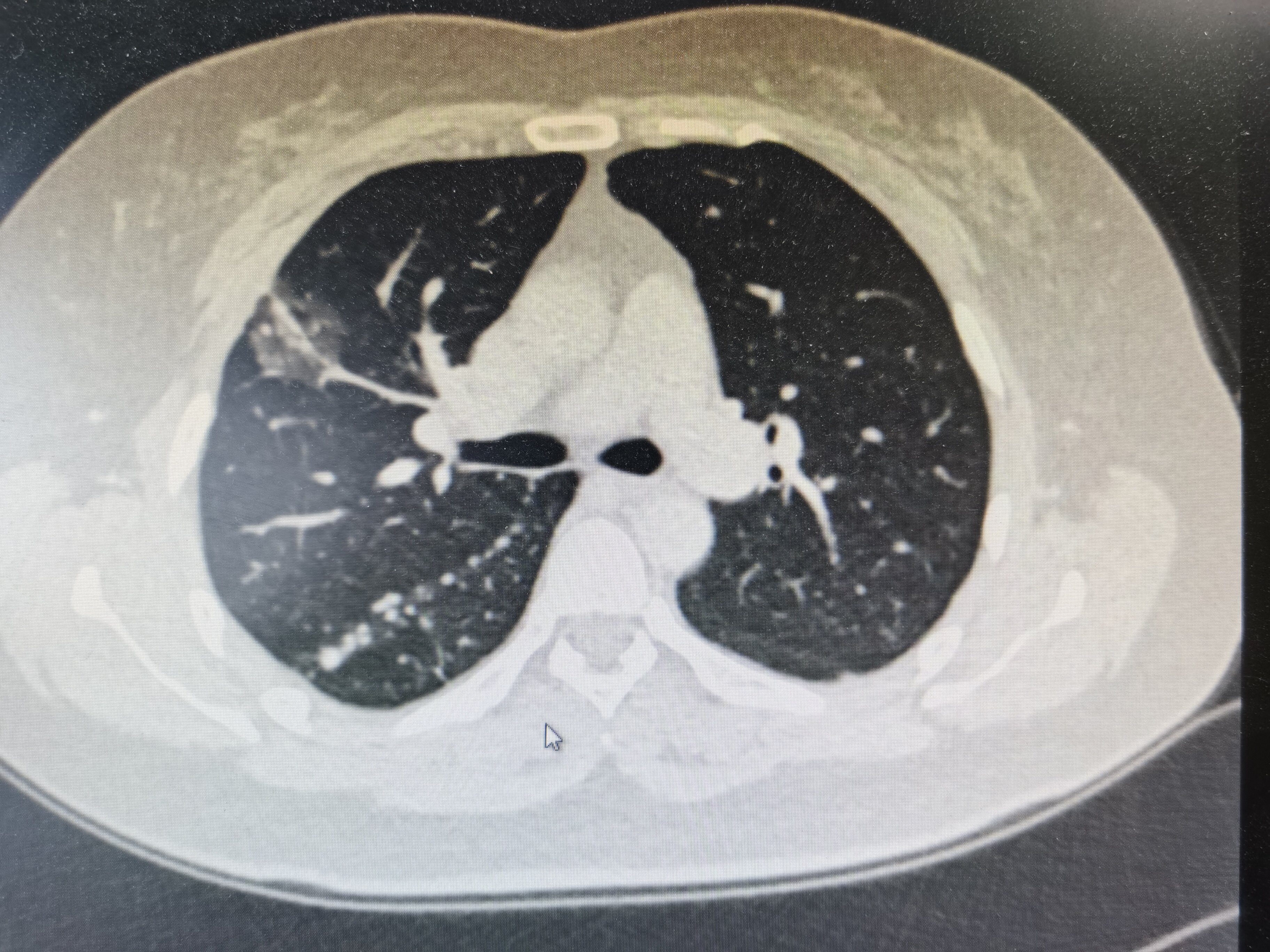 肺结节ct图片螺旋图片
