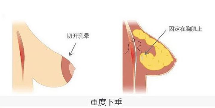 单做假体隆胸可以改善乳房下垂吗?