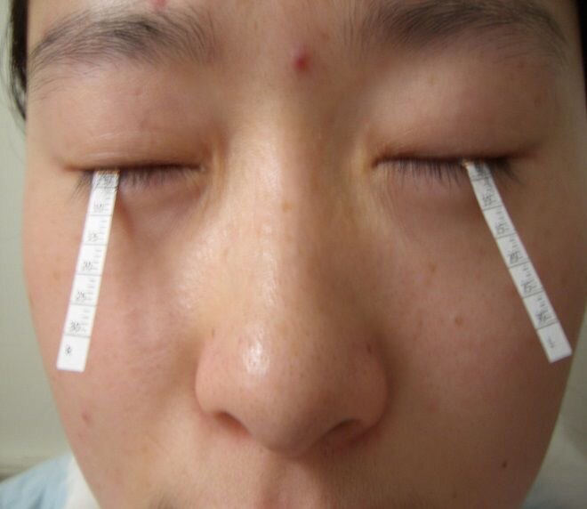 基本检查方法——schirmer test- 睑板腺口阻塞,脓性分泌物.