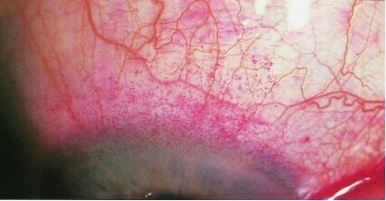 1%虎红/丽丝胺绿- 9分- 鼻侧/颞侧结膜/角膜0分-无染色1分-少量2分