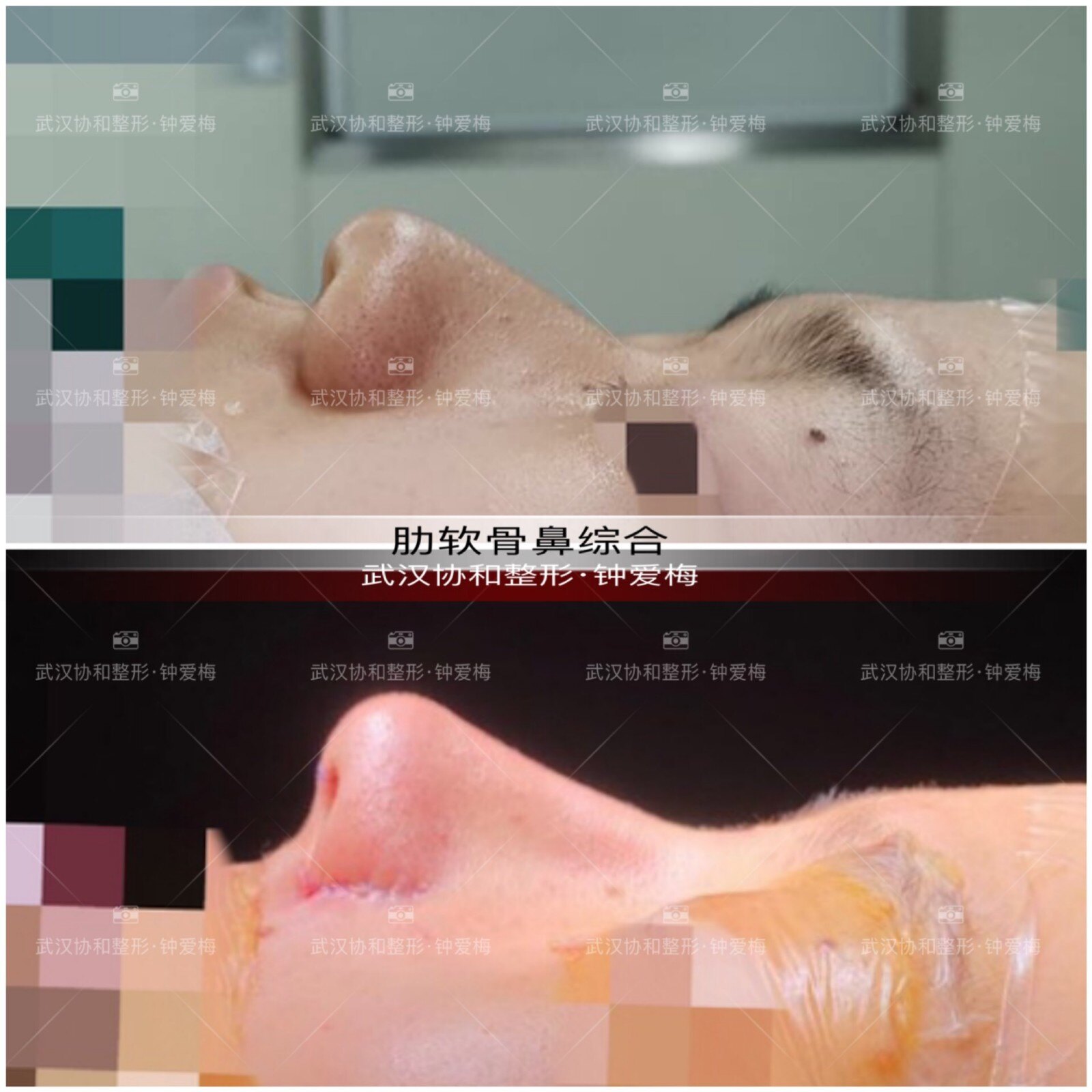 钟爱梅医生肋软骨鼻综合案例分享 肉趴鼻的改变 鼻部整形 好大夫在线