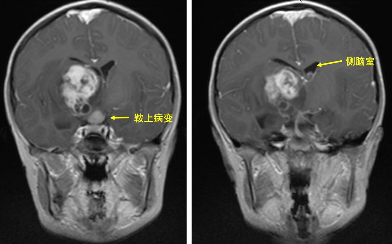 基底節區丘腦生殖細胞瘤的手術和非手術治療