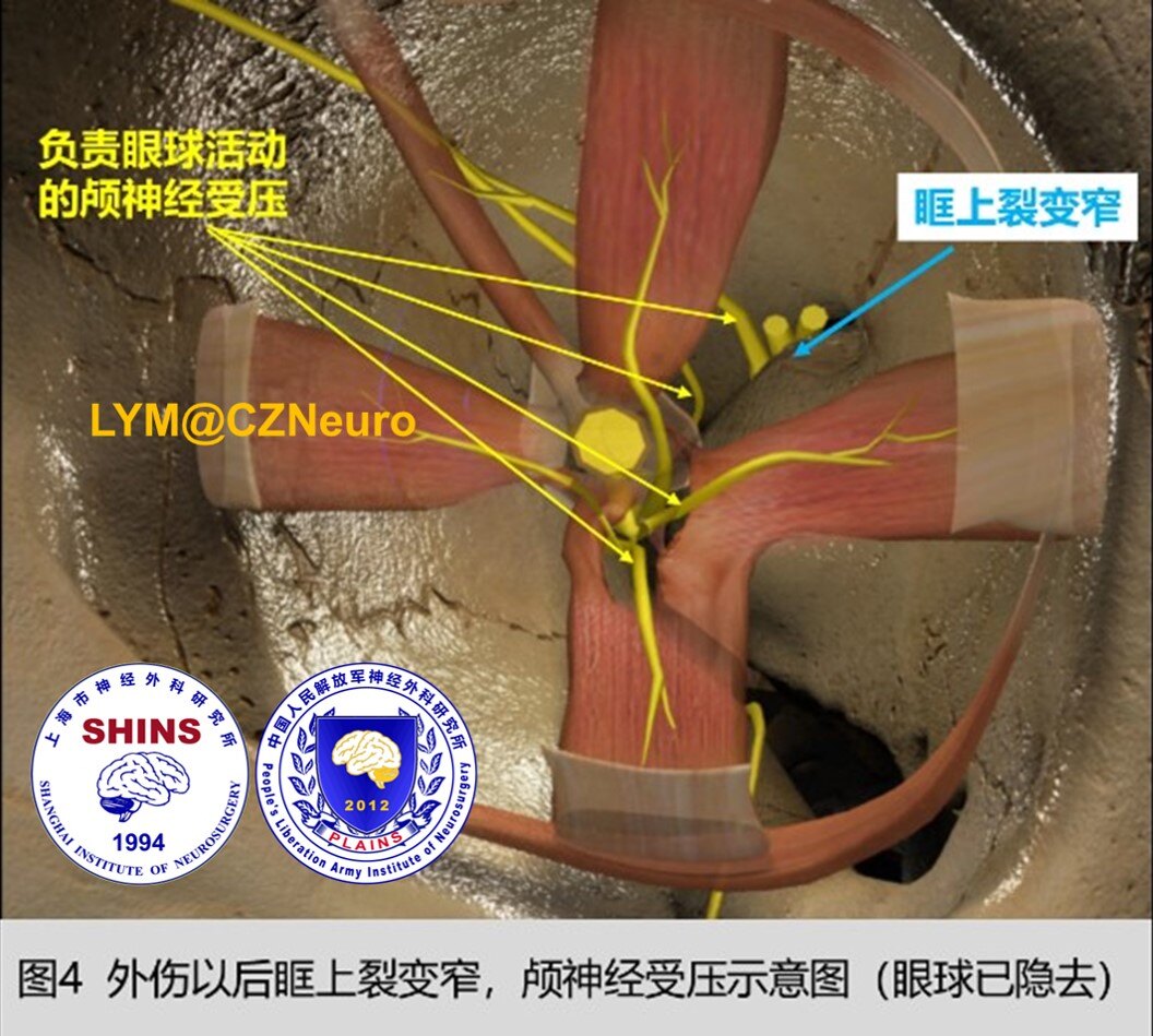 尋找失去的秋波頭部傷後眼瞼下垂視物重影該怎麼治療